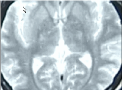 aspartame brain